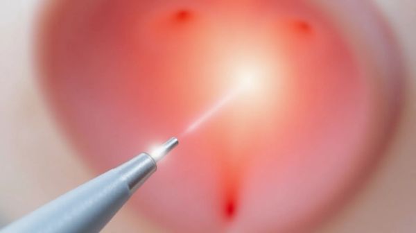 Sécheresse vaginale : comment le laser MonaLisa Touch aide vraiment